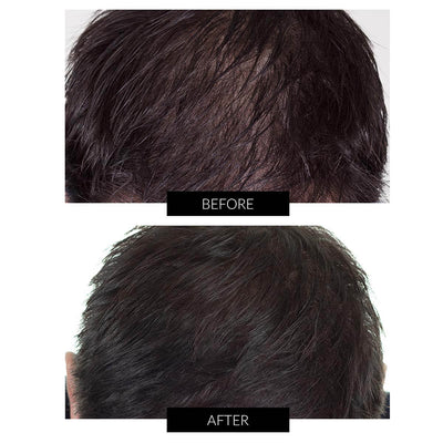 CapillusPlus Hair Regrowth Laser Cap