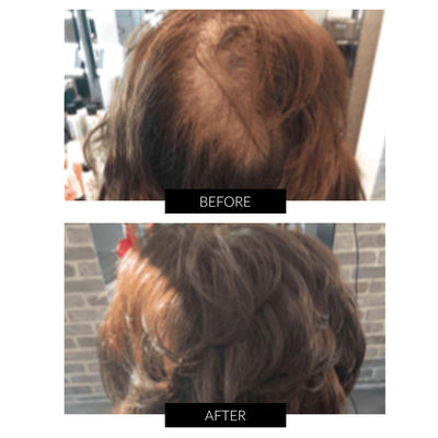 CapillusPlus Hair Regrowth Laser Cap